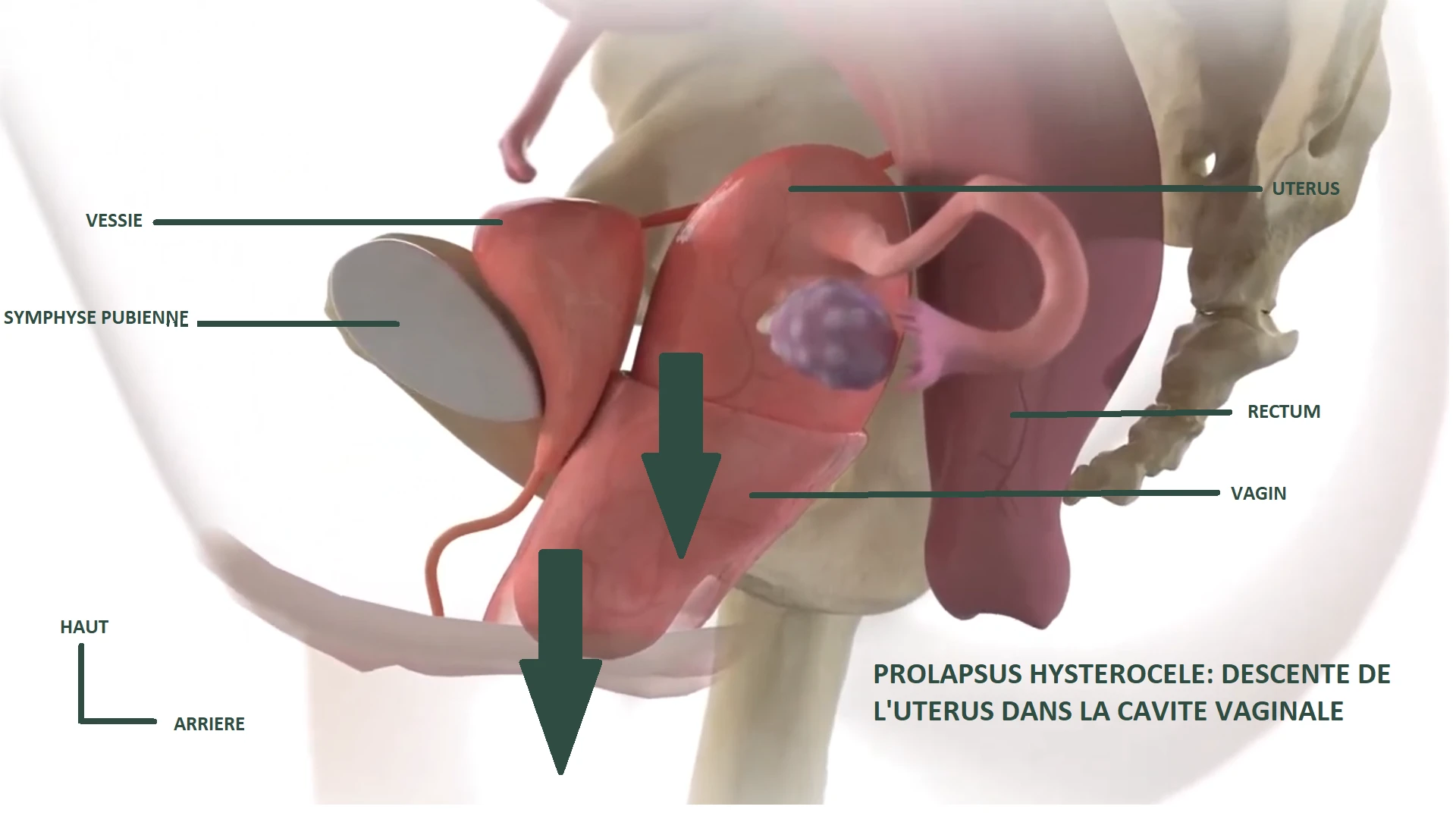 Prolapsus génital féminin - types et prise en charge ostéopathique à Rabat